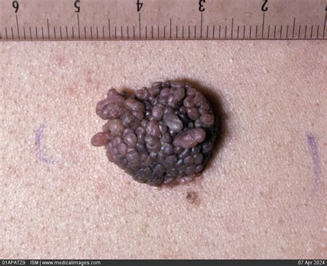 Stock Image Close Up Of A Papillomatous Dermal Nevus Mole A Raised