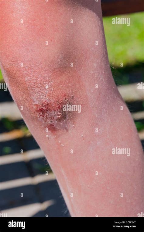 Bloody Wound On The Knee Of A Girl Stock Photo Alamy