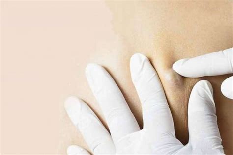 Quiste Epidérmico Qué Es Instituto Dermatologico