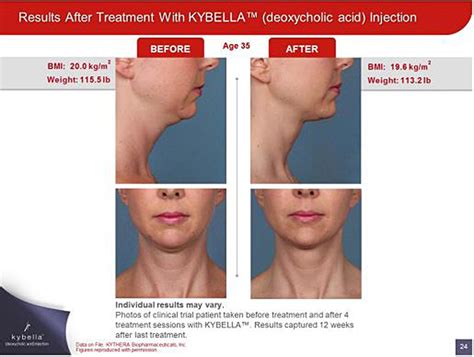 Kybella Connecticut Submental Fat Reduction New Haven Ct