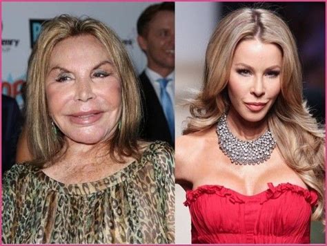 Celebrity Plastic Surgery Cosmetic Surgery Gone Wrong Is It Just