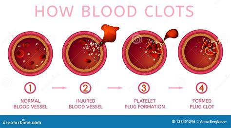 Blood Clotting And Covid 19 Virus Particles Conceptual Illustration