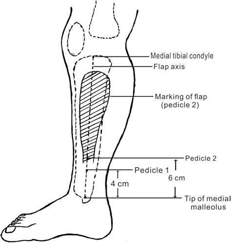 Large Heel Soft Tissue Defects Managed Successfully With Reverse Medial