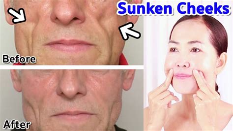 How To Get Fuller Cheeks From Sunken Cheeks No Talking Antiaging