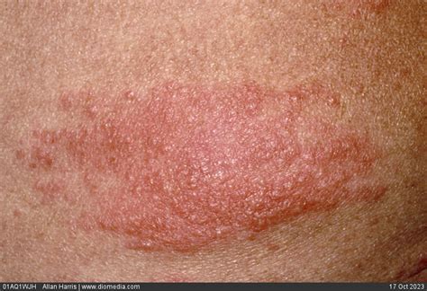 Stock Image Infectious Diseases Shingles Herpes Zoster Cluster Of
