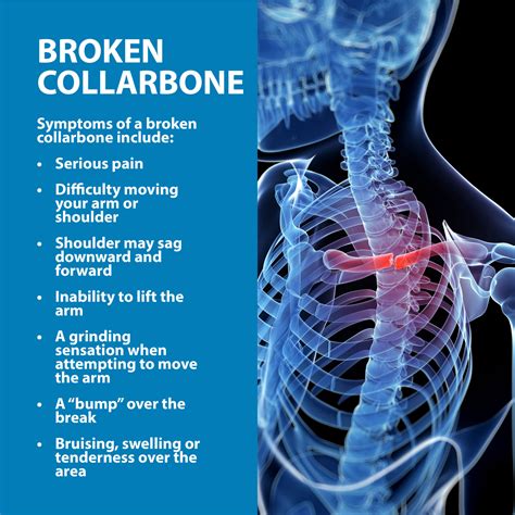 Broken Collarbone Florida Orthopaedic Institute