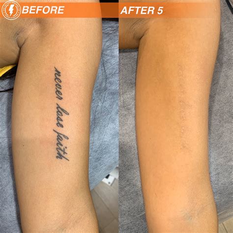 Adelaide S Best Laser Tattoo Removal And Fading Service With