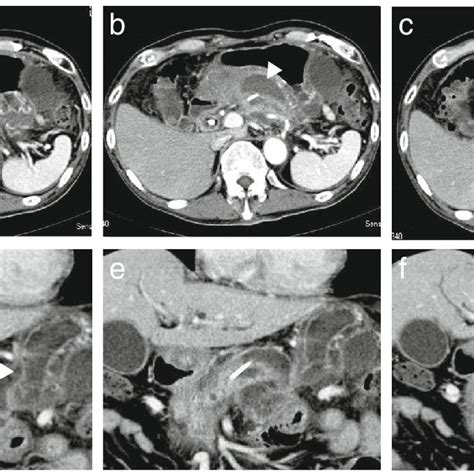 Enhanced Computed Tomography Of The Abdomen A Pancreatic Stent