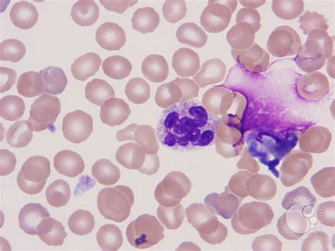 Peripheral Blood Findings In Juvenile Myelomonocytic Leukemia 2