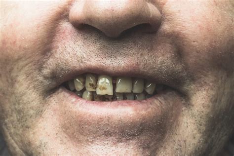 how smoking affects your teeth and gums the daily tooth
