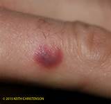 Pictures of Bed Bug Treatment Emedicine