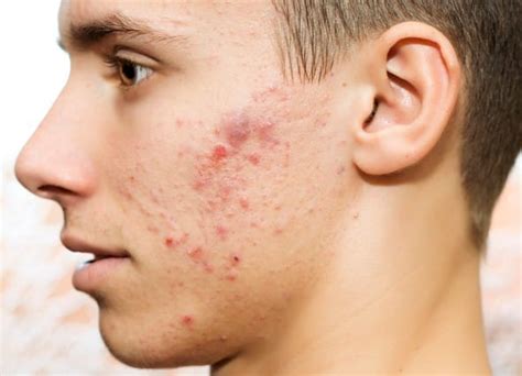 How To Get Rid Of Cystic Acne Dermcare Scannon Dermatology