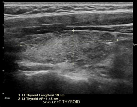 Cureus Hashimotos Thyroiditis Encephalopathy Induced By Covid 19