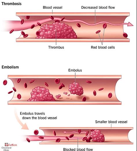 Difference Between Thrombosis And Embolism Relationship Between