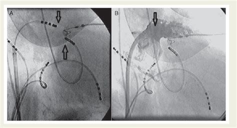 Figure 1 From Radiofrequency Ablation Of Left Atrial Appendage