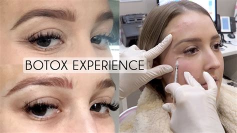 Under Eye Botox Experience And Footage Beforeafter Cost Pain