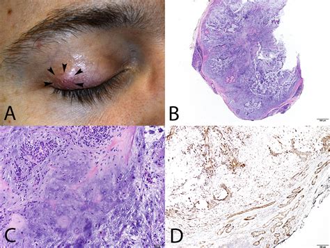Pleomorphic Adenoma Of An Accessory Lacrimal Gland Masquerading As A Chalazion Ophthalmology