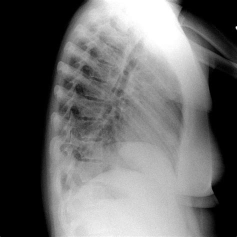 Granulomatosis With Polyangiitis Chest X Ray Wikidoc