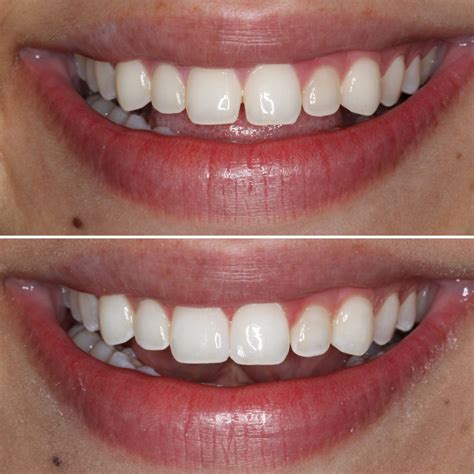 6 Common Cosmetic Dental Procedures Explained