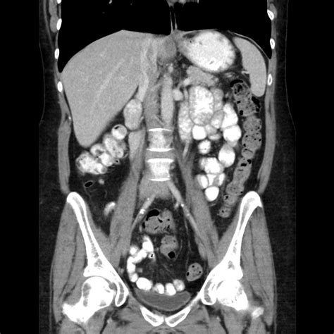Normal Abdominal Ct Scan With Contrast