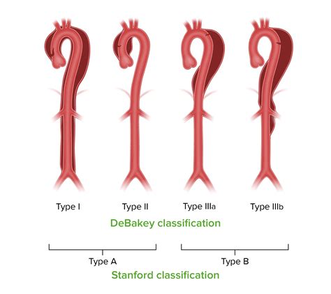 Type B Aortic Dissection Treatment Uptodate
