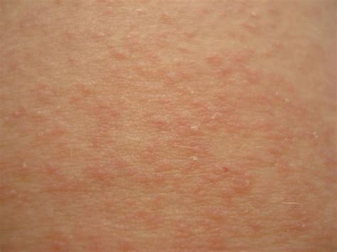 What Is Prickly Heat Rash