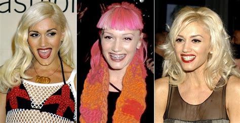 Gwen Stefani Rocked Her Braces As Fashion Ill Grills Celebrity Teeth