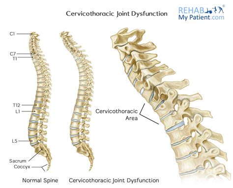 Cervicothoracic Joint Ct Dysfunction Rehab My Patient