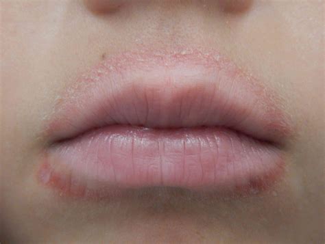 Skin Rash And Swollen Lips