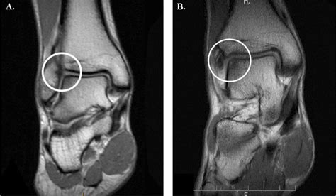 Mri Of The Right Ankle Coronal Views At 4 Months Prior To