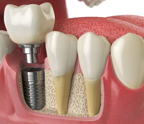 Dental Implant Specialist In Phoenix AZ Dental Implants In AZ