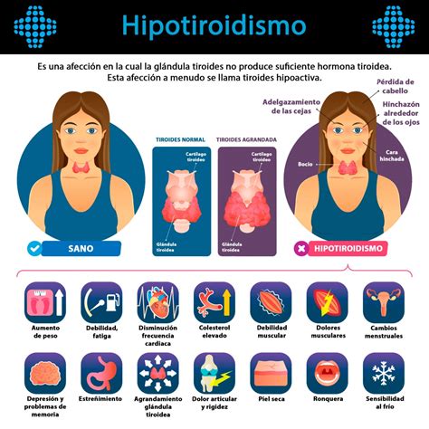 Infografia Tiroides Hipotiroidismo E Hipertiroidismo