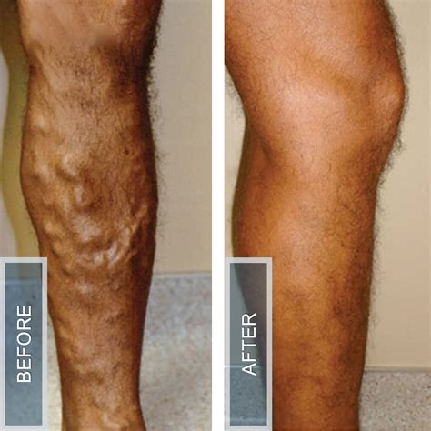 Veins Before And After Vein Institute Of The Desert