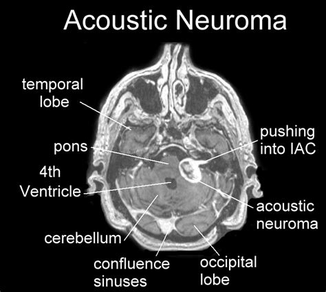Vestibular Schwannoma Acoustic Neuroma Best Treatment