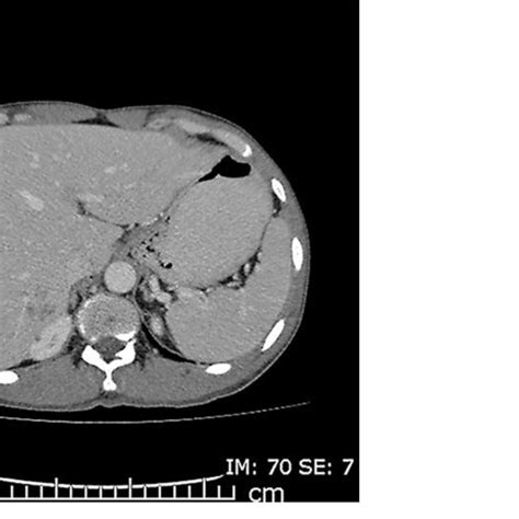 Contrast Enhanced Axial Ct Image At Portal Venous Phase Shows Clustered
