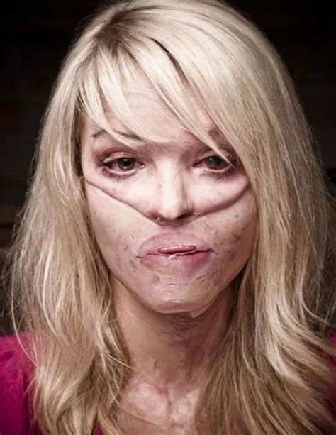 Katie Piper Acid Attack What Happened To The Strictly Come Dancing