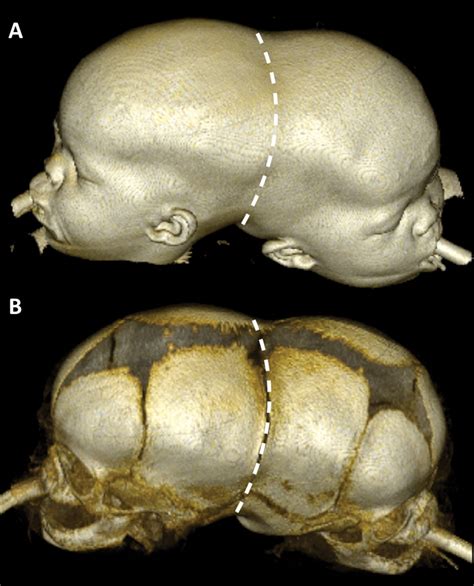 Multiparametric Imaging For Presurgical Planning Of Craniopagus Twins