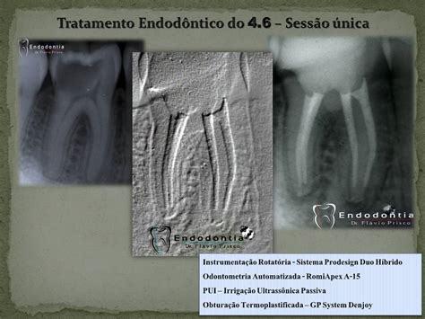 Descobrindo e explorando a Endodontia Tratamento Endodôntico do Condutos
