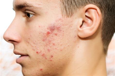 Cystic Acne Symptoms Causes And Treatments Tennessee Telederm