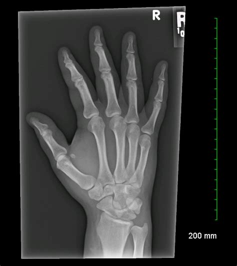 Hand Bone Anatomy X Ray