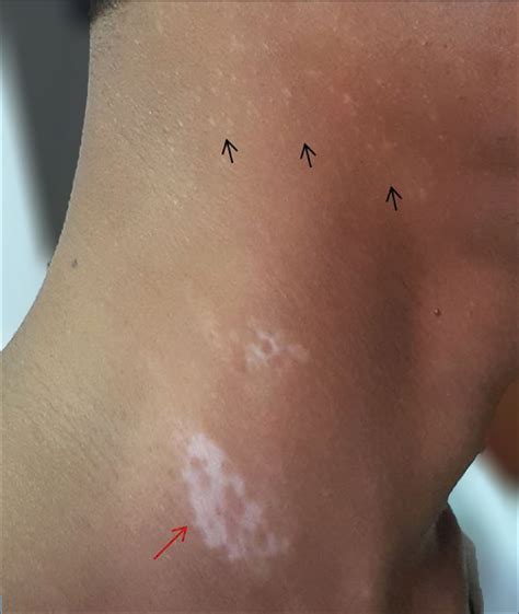 Dermoscopy An Easy Way To Solve The Diagnostic Puzzle In Pityriasis Versicolor Indian Journal