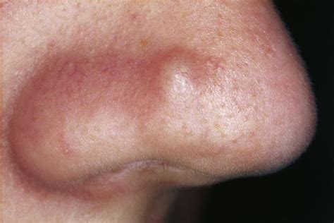 Bumps On The Skin Pictures Causes And Treatments