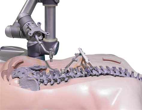 Robotic Spine Surgery And Augmented Reality Scopespine Virginia