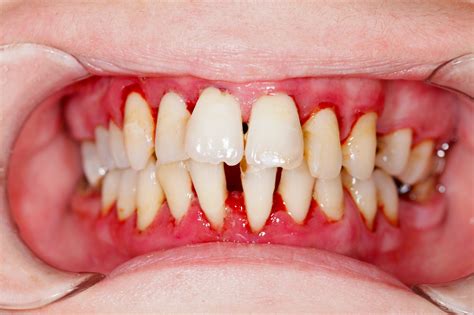 4 Telltale Signs Of Gum Disease