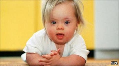Ivf Procedure May Increase Risk Of Downs Syndrome Bbc News