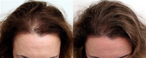 Female Hair Loss Manhattan Nyc True And Dorin Medical Group Hair