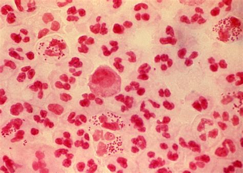 A microbial biorealm page on the genus neisseria gonorrhoeae. Core Concepts - Gonorrhea - Pathogen-Based Diseases ...