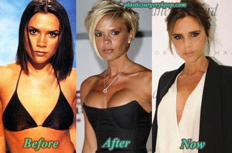 Victoria Beckham Plastic Surgery Before After Pictures Victoria Beckham Victoria Beckham News