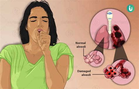 Emphysema Symptoms Causes Treatment Medicine Prevention Diagnosis