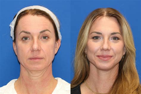 Patient 87147711 Fat Transfer Before And After Photos Carmel Valley